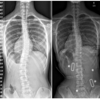 Scoliosis 3DC - Chiropractors Near Me - Woburn, Massachusetts Scoliosis 3DC - Chiropractors Near Me - Woburn, Massachusetts
