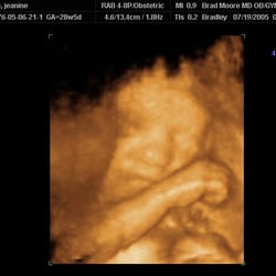 Moore Bradley, MD - About 28 Weeks
