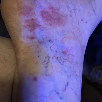My Self Storage Space - My legs and heels were severely reacting to mold poisoning! - Self Storage Near Me - Camarillo, California