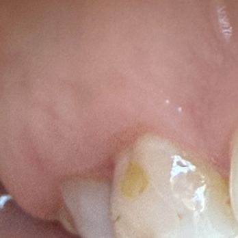 Inspired Dental - Update 1/29/2025: faulty cleaning removed too much enamel and now another tooth is breaking and enamel falling off - General Dentistry Near Me - Las Vegas, Nevada Inspired Dental - Update 1/29/2025: faulty cleaning removed too much enamel and now another tooth is breaking and enamel falling off - General Dentistry Near Me - Las Vegas, Nevada