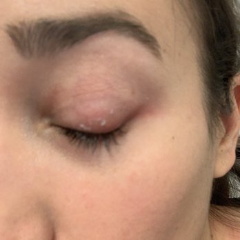 Anita B Spa - Some of the glue on my eyelid - Skin Care Near Me - San Francisco, California Anita B Spa - Some of the glue on my eyelid - Skin Care Near Me - San Francisco, California