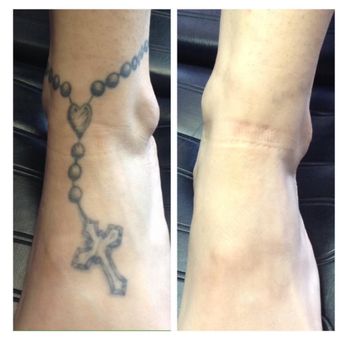 Disappearing inc. - Tattoo Removal Near Me - Braintree, Massachusetts Disappearing inc. - Tattoo Removal Near Me - Braintree, Massachusetts