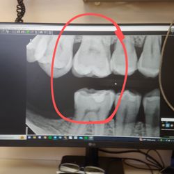 Prohealth Dental - Here's an X-ray of said tooth/teeth for anyone interested.