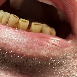 A gap I never had until Associated Dental did thier shoddy work.