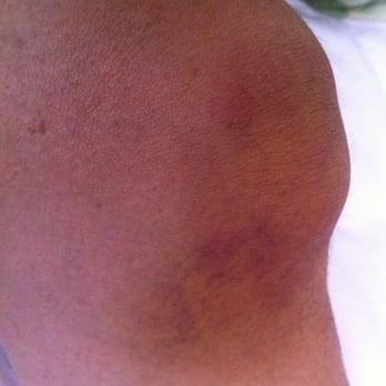 Spa Castle - be careful. this is what may happen to you due to slippery floors/ no flip-flops rule/ apathetic staff! - Massage Near Me - College Point, New York