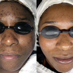 Acne Specialists of Long Beach - Hyperpigmentation who? not here.