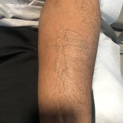 Winter Park Tattoo Removal - Frosting after tattoo removal