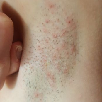 Hotel Croydon Miami Beach - BED BUG BITES ***BEWARE*** - Hotels Near Me - Miami Beach, Florida Hotel Croydon Miami Beach - BED BUG BITES ***BEWARE*** - Hotels Near Me - Miami Beach, Florida