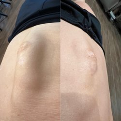 Mariam’s Aesthetic Clinic  - Diastasis recti improvement with 6 sessions!