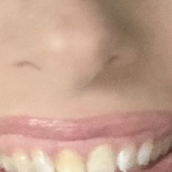 Wakim Cosmetic and Family Dental Group - Before photo, dead tooth is discolored and pushed back.