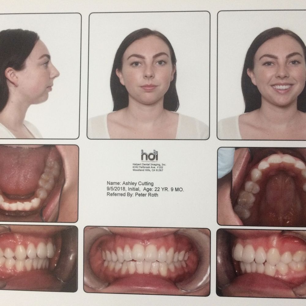 Peter Roth, DDS MSD - Bite prior to getting braces. - Orthodontists Near Me - West Hills, California Peter Roth, DDS MSD - Bite prior to getting braces. - Orthodontists Near Me - West Hills, California