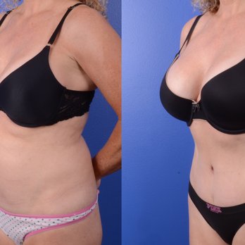Marin Aesthetics - Modified Tummy Tuck and Lipo at 4 months - Cosmetic Surgeons Near Me - La Jolla, California Marin Aesthetics - Modified Tummy Tuck and Lipo at 4 months - Cosmetic Surgeons Near Me - La Jolla, California