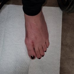 James J Longobardi, DPM - Absolute Foot Care - Post op Lapiplasty