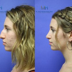 Matt Hershcovitch, MD - Rhinoplasty Before and After