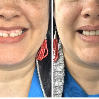 Steven L Rasner DMD MAGD - Same day, before and after. My lip was numb due to the surgery and I had to hold my lip up to show my teeth. - General Dentistry Near Me - Vineland, New Jersey Steven L Rasner DMD MAGD - Same day, before and after. My lip was numb due to the surgery and I had to hold my lip up to show my teeth. - General Dentistry Near Me - Vineland, New Jersey