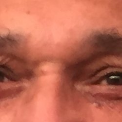 Saint Luke's Plastic Surgery Specialists-Plaza - Before photo. I went there for sagging skin on my right eye. Left eye is fine.