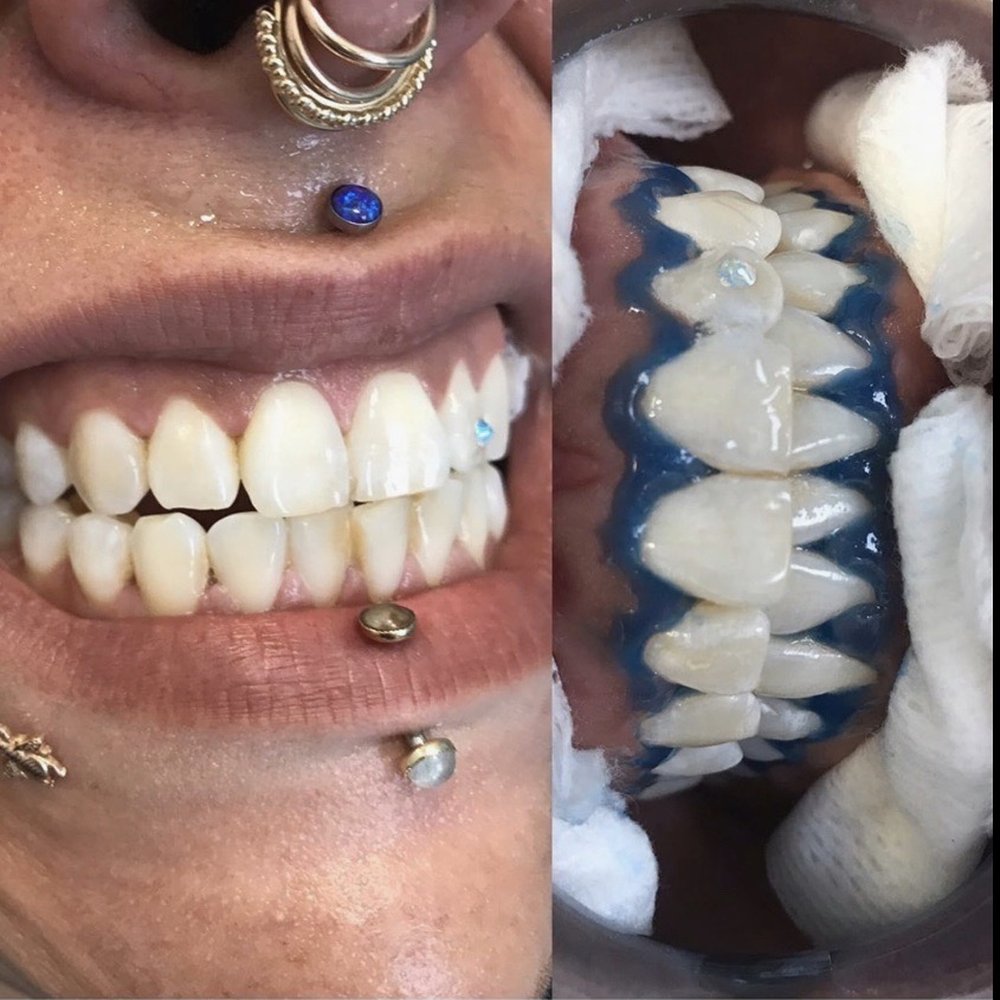 Teeth Jewel - My after photo!!! - Dental Hygienists Near Me - Dallas, Texas Teeth Jewel - My after photo!!! - Dental Hygienists Near Me - Dallas, Texas