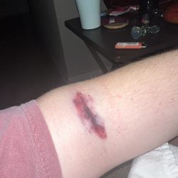 ADMA BioCenters - Myrtle Beach - Messed up arm