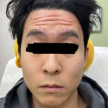 Delight Skin Clinic - Before the Botox treatment - Skin Care Near Me - Torrance, California Delight Skin Clinic - Before the Botox treatment - Skin Care Near Me - Torrance, California