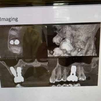 Esther Min, DDS - 3D image of outdated implant type & bone loss - Cosmetic Dentists Near Me - Tacoma, Washington Esther Min, DDS - 3D image of outdated implant type & bone loss - Cosmetic Dentists Near Me - Tacoma, Washington