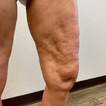 Rozbeh Torabi - my legs after - Cosmetic Surgeons Near Me - Phoenix, Arizona