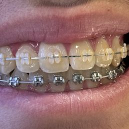 Braces Braces