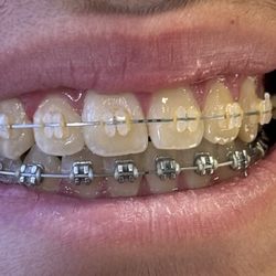 Sunga Orthodontics - Braces