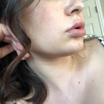 Tri-Valley Medical Center - Lip injections done by Dr. Marwaha! - Medical Spas Near Me - San Ramon, California Tri-Valley Medical Center - Lip injections done by Dr. Marwaha! - Medical Spas Near Me - San Ramon, California
