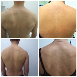 Zapatat - Full back tattoos full removal
