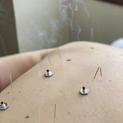 Acupuncture and Moxibustion (Moxa)