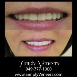 Simply Veneers - Complete smile makeover, note the difference between her old veneers and the new layered porcelain veneers Smile restored confidence renewed
