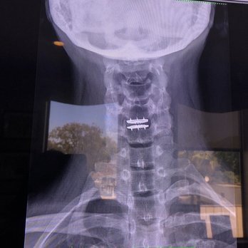 Lanman H Todd, MD - Lanman Spinal Neurosurgery - 4 years later, be sure to look at the one right after surgery and compare. - Spine Surgeons Near Me - Beverly Hills, California