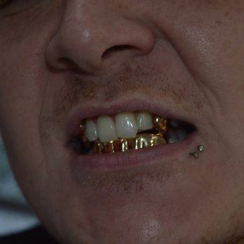 Baltimore Gold Fronts - Jewelry Near Me - Baltimore, Maryland Baltimore Gold Fronts - Jewelry Near Me - Baltimore, Maryland