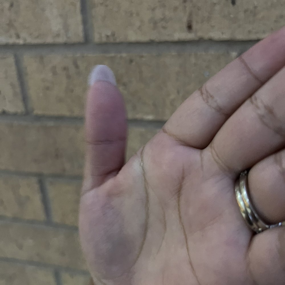Short thumb nail. Way shorter than the rest of nails