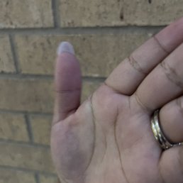 Short thumb nail. Way shorter than the rest of nails