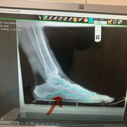Burbank Podiatry Associates Group - Dislocated bone , flat feet