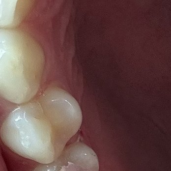 Sage Dental - Root canal- before crown - Orthodontists Near Me - Greenacres, Florida Sage Dental - Root canal- before crown - Orthodontists Near Me - Greenacres, Florida