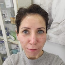 Second visit, yesterday we did mezzo therapy facial. I can't wait ti see the results!! You can see my face is already GLOWING!!! :)