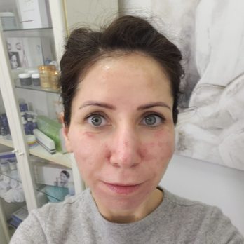 Golden Day Spa - Second visit, yesterday we did mezzo therapy facial. I can't wait ti see the results!! You can see my face is already GLOWING!!! :) - Day Spas Near Me - Chicago, Illinois