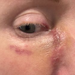 Las Vegas Skin & Cancer Clinics - 2 Weeks After Surgery