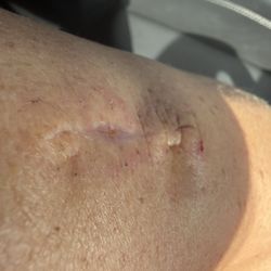 Pacific Dermatology Institute - Botched excision would not recommend this doctor