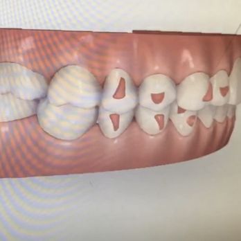 Jerry K Wu, DMD - Smiles Advantage - After -Simulation to show the result should be - General Dentistry Near Me - Tustin, California Jerry K Wu, DMD - Smiles Advantage - After -Simulation to show the result should be - General Dentistry Near Me - Tustin, California
