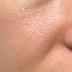 Laser and Cosmetic Associates of Boulder - Skin damage and inflammation after chemical peel.
