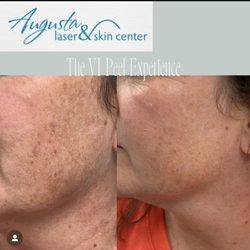 Augusta Laser & Skin Center - Real results after one Vi peel in office. Skin is more even and brighter.