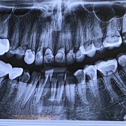 Delicate Oral Surgery - Back right tooth that shows how it's pushing on 5!4 membrane they were worried about & all my dental work
