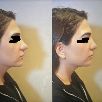 Profiles Beverly Hills Plastic Surgery - On the left is original. On the right is what they promised. - Plastic Surgeons Near Me - Beverly Hills, California