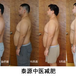 DAO Acupuncture Clinic - Acupuncture for weight lose - Real patient Before - after 15 days - after 2 months- after 3 month