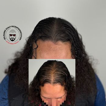 Delaware Scalp Micropigmentation - Delaware SMP offers realistic, non-surgical hair loss solutions for men. Look sharp, feel confident, stay bold. - Hair Loss Centers Near Me - Wilmington, Delaware Delaware Scalp Micropigmentation - Delaware SMP offers realistic, non-surgical hair loss solutions for men. Look sharp, feel confident, stay bold. - Hair Loss Centers Near Me - Wilmington, Delaware