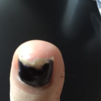 Top Nail Design - Toe nail after one week chipped and also destroyed under the polish -After one more week I lost nail from the root! - Nail Salons Near Me - Brooklyn, New York Top Nail Design - Toe nail after one week chipped and also destroyed under the polish -After one more week I lost nail from the root! - Nail Salons Near Me - Brooklyn, New York
