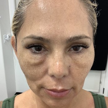 American Beauty Med Spa - Before picture with bags and saggy skin and lots of sun spots :( - Medical Spas Near Me - Lake Forest, California